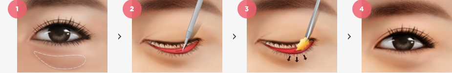 Lower Eyelid Fat Removal (Dark Circle) Surgery Method