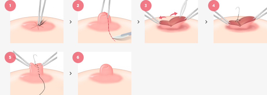 Inverted Nipple Correction Surgery Method
