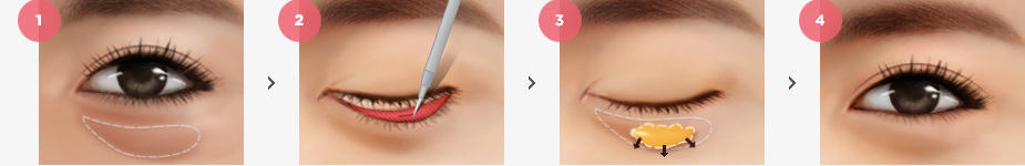 Lower Eyes Fat Realignment (Dark Circle) Surgery Method